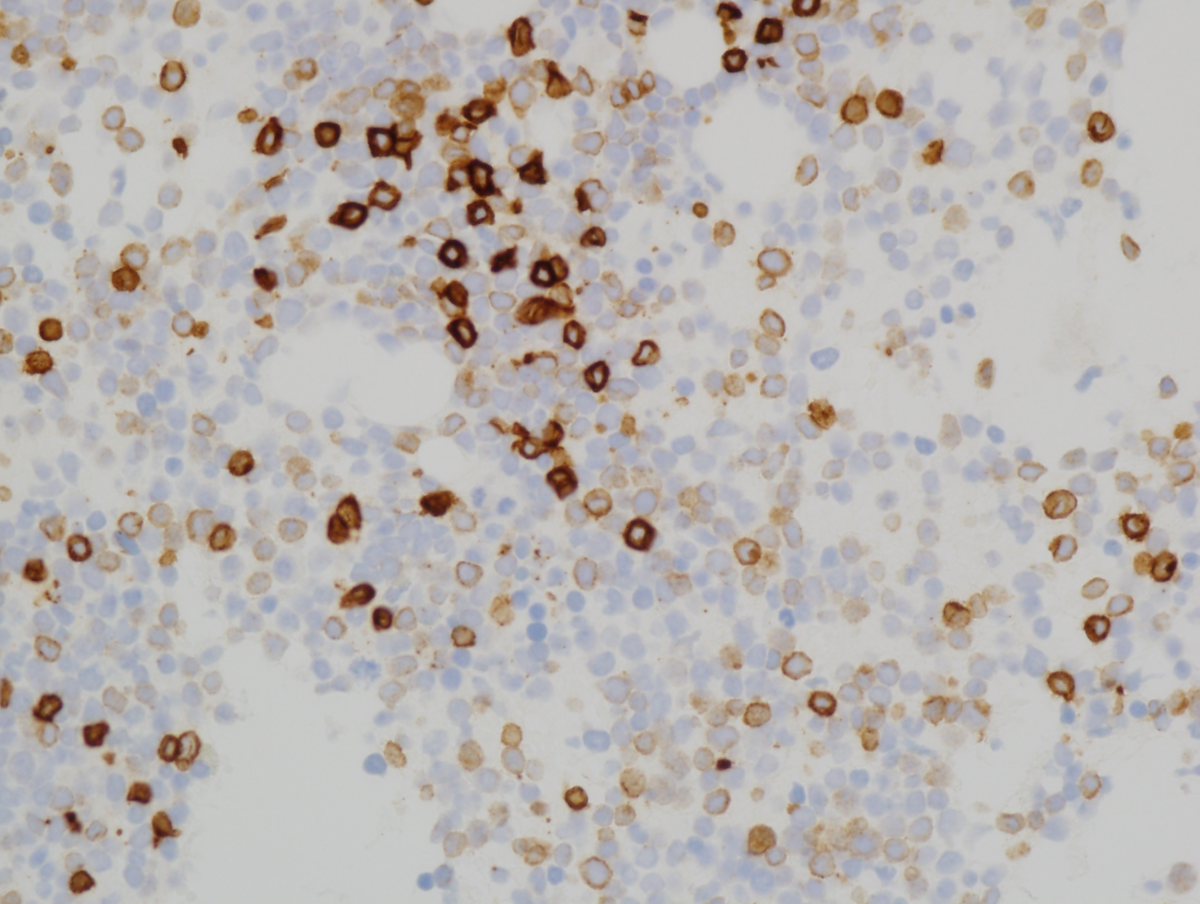 Figure 5(CD3): Immunohistochemistry of bone marrow clot sections (400x magnification).